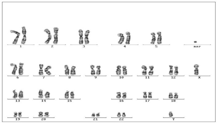 Thirty-Three Years Follow-Up of a Greek Family with Abetalipoproteinemia: Absence of Liver Damage on Long-Term Medium Chain Triglycerides Supplementation.
