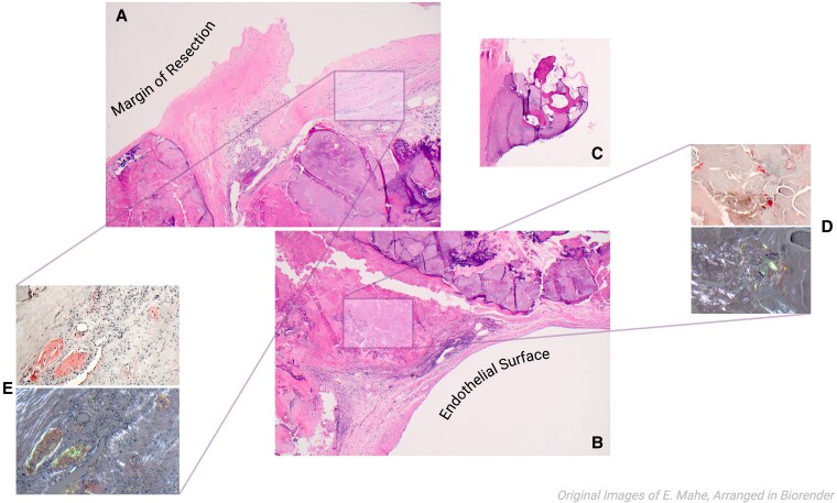 Case report of isolated aortic valve AL-amyloidosis following aortic valve replacement.