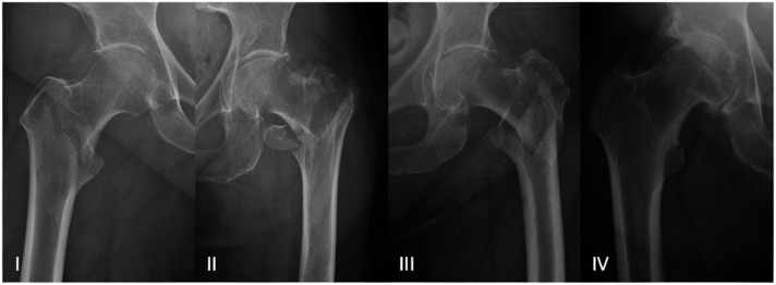 The Effect of Pre-existing Advanced Osteoarthritis in Trochanteric Femoral Fractures on Post-intramedullary Nailing Quality of Life - A Retrospective Study.