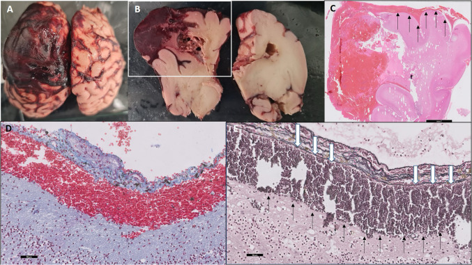 Antenatal subpial hemorrhage diagnosed by fetal magnetic resonance imaging: imaging spectrum and autopsy findings.