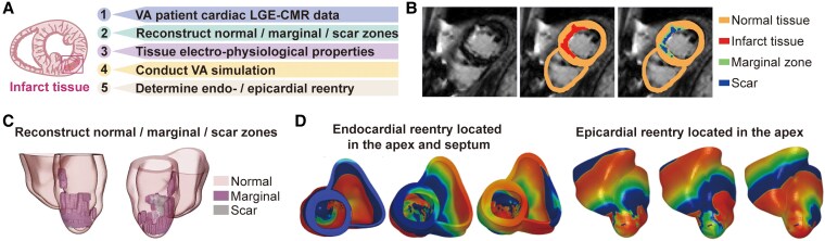 Case report of ventricular tachycardia simulation facilitated ablation for refractory ventricular arrhythmia post-myocardial infarction: aiming before firing.