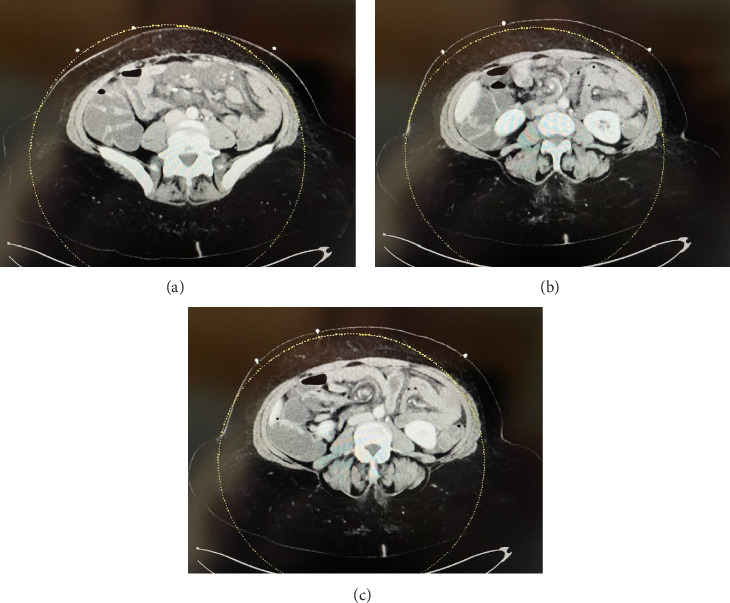 Lymphatic Obstruction Related to Small Bowel Obstruction With Chylous Ascites in Prior Roux En Y Gastric Bypass Patient Case Report.