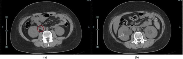 Bilateral Ureteral Lithiasis and Postrenal Acute Kidney Injury: A Rare Complication of Diabetic Ketoacidosis in a Child.