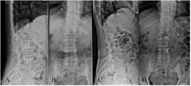 Percutaneous Vertebroplasty Using GeneX<sup>®</sup> in Osteoporotic Vertebral Compression Fractures: A Case Report.