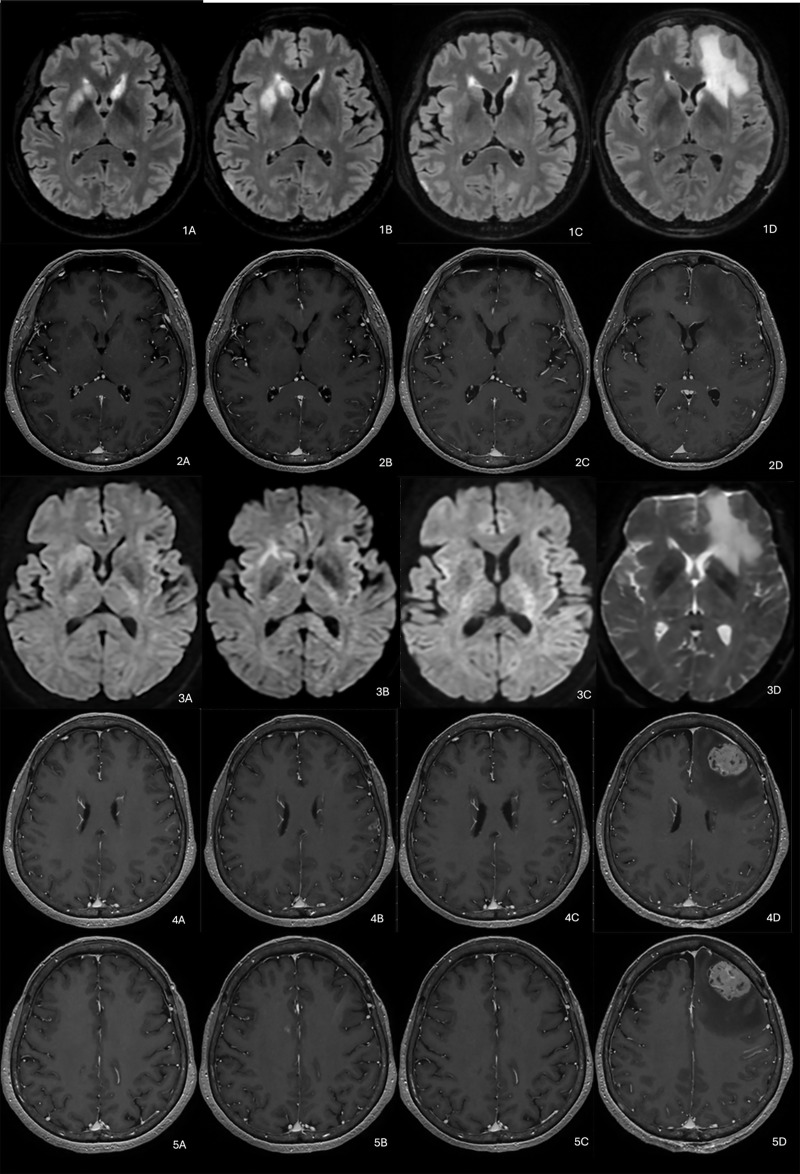 Primary Central Nervous System B-Cell Lymphoma Presenting with Fluctuating Basal Ganglia and Cortical Lesions.