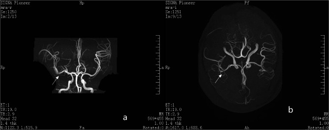 Intravenous tenecteplase thrombolysis and endovascular bridging intra-arterial tirofiban injection therapy in a pediatric case of acute ischemic stroke.