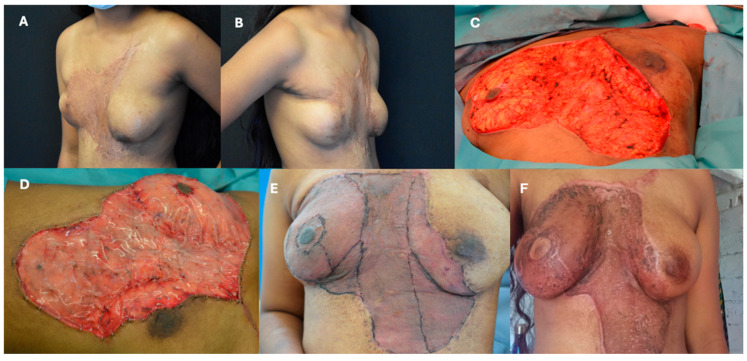 Use of Integra<sup>®</sup> Dermal Regeneration Template Bilayer in Burn Reconstruction: Narrative Review, Expert Opinion, Tips and Tricks.