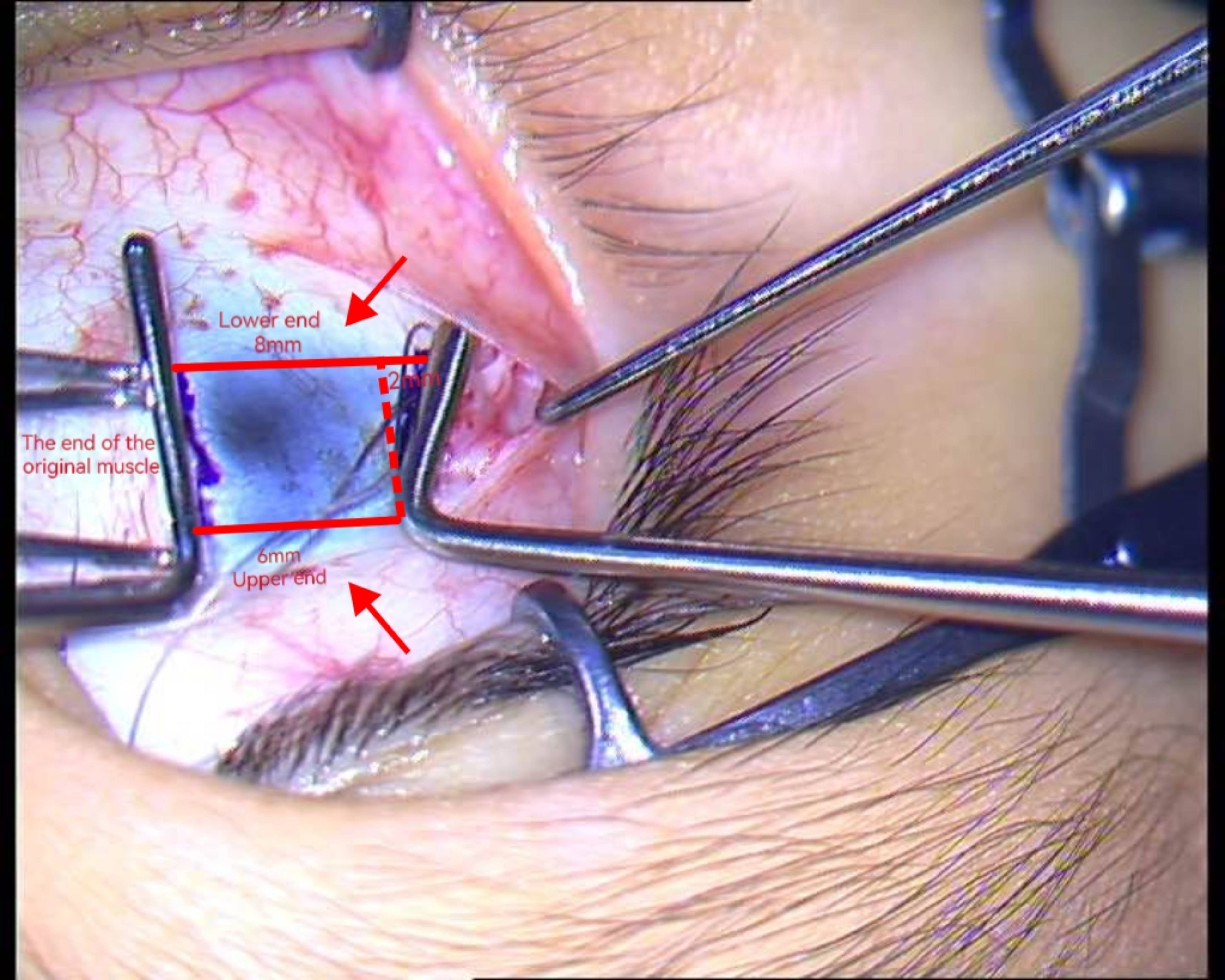 Impact of slanted lateral rectus recession on pediatric patients with convergence insufficiency intermittent exotropia.