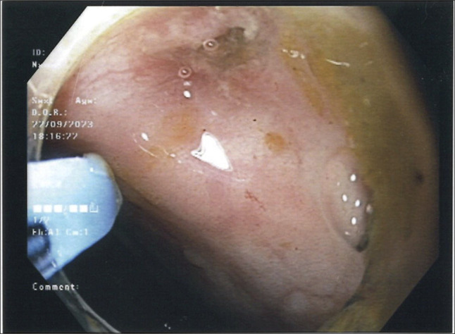 Endoscopic Treatment of a Colovesical Fistula Using a Through-The-Scope Clip Designed for Large Defect Closure.