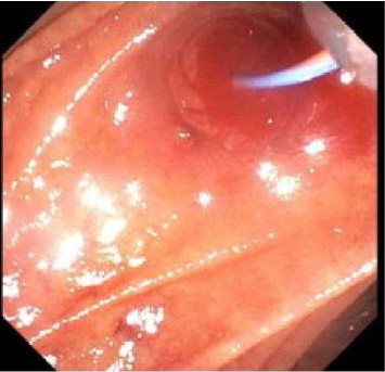 Hemostasis With Fully Covered Self-Expanding Bare Metal Stent as a Bridge to Liver Transplantation in a Patient With Acute Liver Failure and Hemodynamically Unstable Hemobilia.