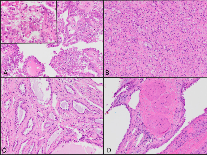 Bilateral, multicystic fumarate hydratase-deficient renal cell carcinoma in patient with hereditary leiomyomatosis & renal cell carcinoma syndrome: A case report and review of the literature.