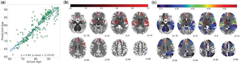 An explainable AI approach for mapping multivariate regional brain age and clinical severity patterns in Alzheimer's disease.