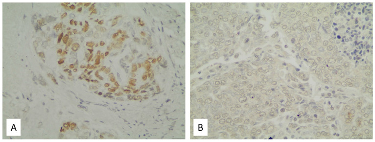 PROX1 Expression in Resected Non-Small Cell Lung Cancer: Immunohistochemical Profile and Clinicopathological Correlates.