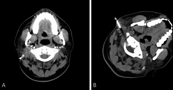 A percutaneous core needle biopsy of deep suprahyoid head and neck lesions with CT-guided: study of diagnostic performance and factors associated with diagnostic failure.