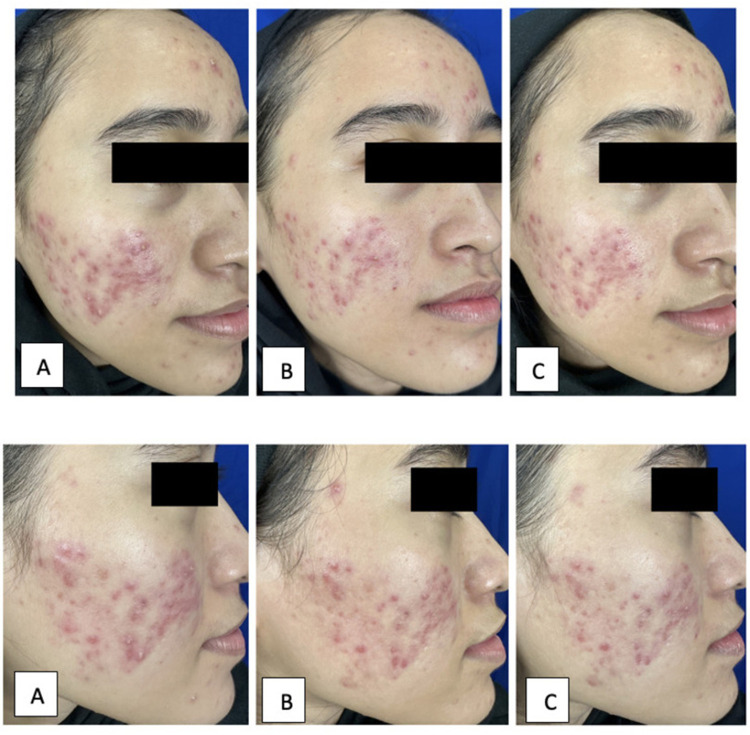 The Comparable Efficacy Between Tranexamic Acid Intradermal Injection and Pulsed Dye Laser for Treatment of Post-Acne Erythema: A Split-Face Therapy.
