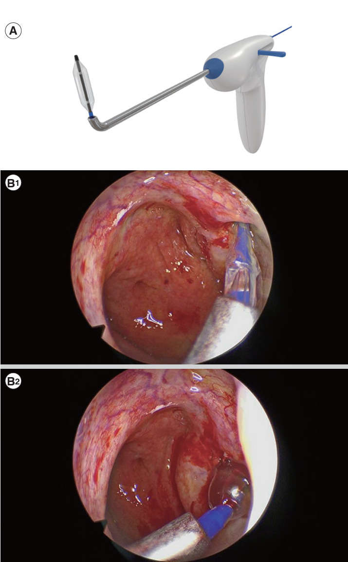 Balloon Eustachian Tuboplasty in Chronic Suppurative Otitis Media and Dilatory Eustachian Tube Dysfunction: A Randomized Controlled Trial.