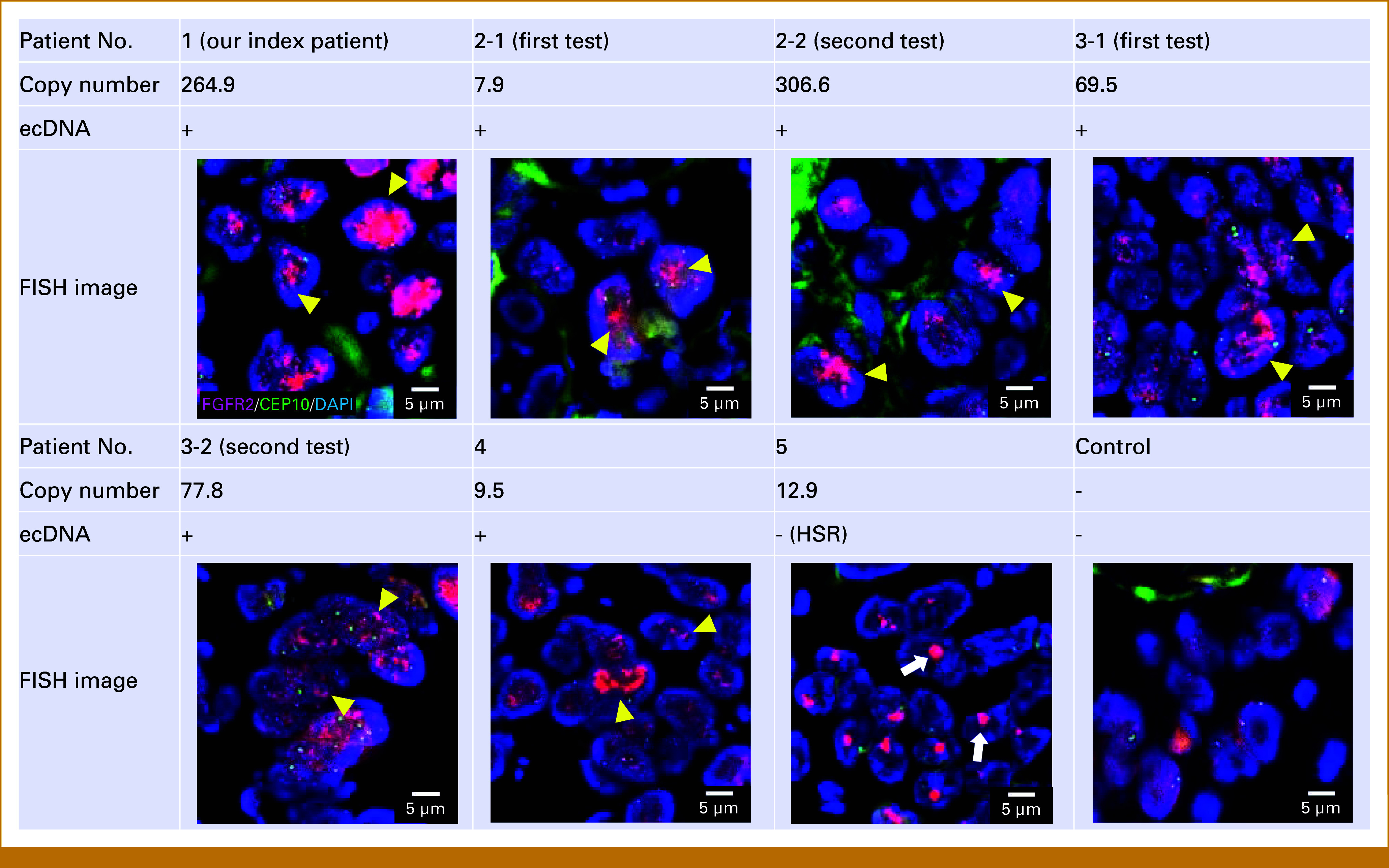 Clinical Significance of Extrachromosomal DNA in <i>FGFR2</i>-Amplified Gastric Cancer: Therapeutic Implications From Clinical Experience.