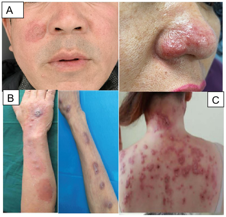 Updates on Current Situation of Cutaneous Sporotrichosis: A Narrative Review.