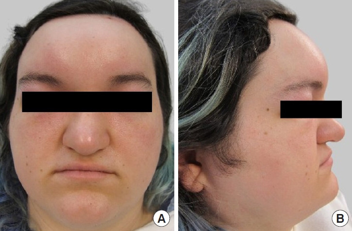 Pott puffy tumor following upper facial feminization surgery: a case report and literature review.
