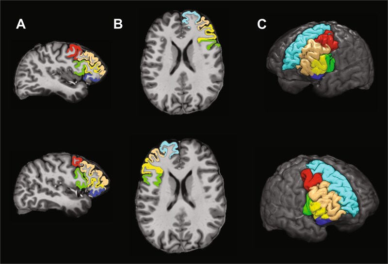 Generalized learning induced by training and tDCS is predicted by prefrontal cortical morphology.