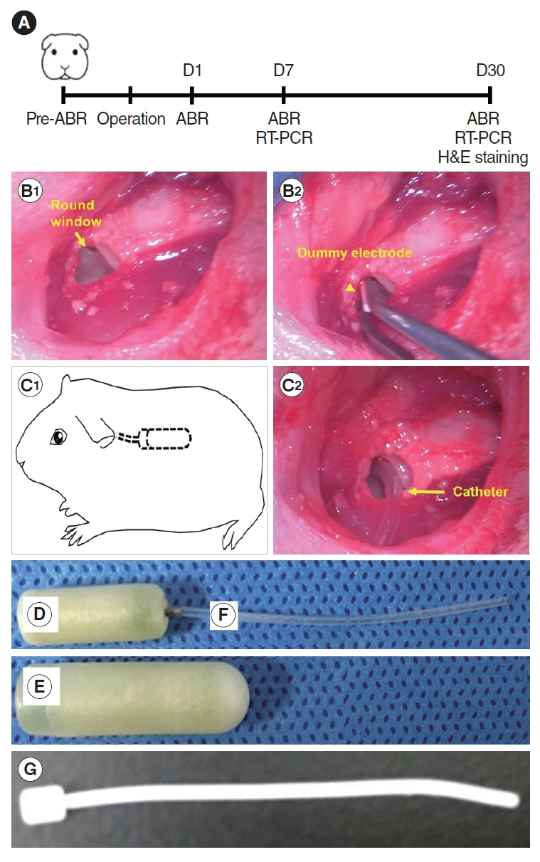 Sarpogrelate Delivered via Osmotic Pump Improves Residual Hearing Preservation After Cochlear Implantation.