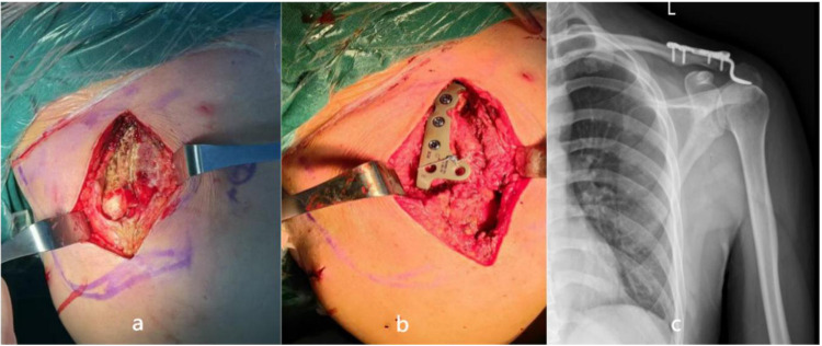 Clinical and Radiological Assessment of Modified Weaver-Dunn Technology, Arthroscopic Single Tunnel Technique and Arthroscopic Coracoid Sling Technique Three Different Surgical Techniques in the Treatment of Acute Rockwood III-V Acromioclavicular Dislocations.
