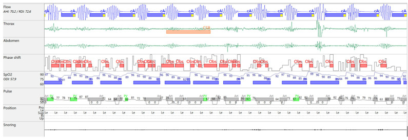 Adaptive Servo-Ventilation for Central Sleep Apnea in an Anemic Patient with Cardiac Disease: A Case Report.