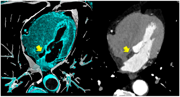 Lipomatous Hypertrophy of the Interatrial Septum (LHIS) a Biomarker for Cardiovascular Protection? A Hypothesis Generating Case-Control Study.