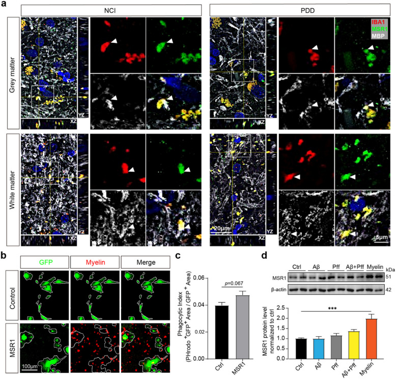 Correction: Single-nucleus transcriptomics reveals a distinct microglial state and increased MSR1-mediated phagocytosis as common features across dementia subtypes.
