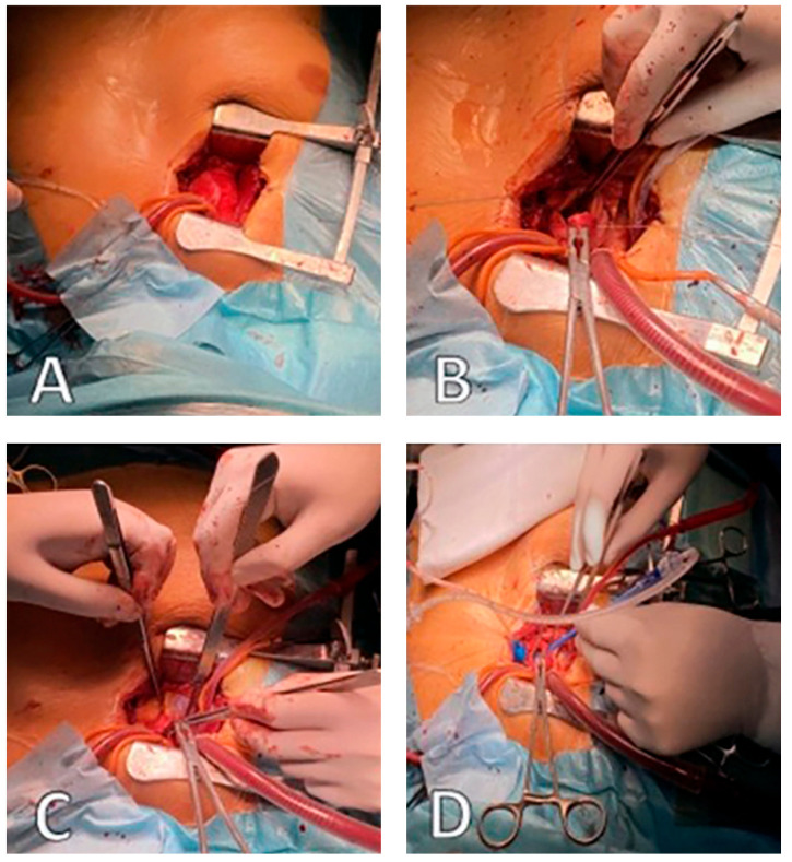 Comparison of Surgical Treatment Outcomes in Patients with Symptomatic Severe Aortic Valve Stenosis Using the Perceval Sutureless Bioprosthesis Versus a Conventional Biological Valve.