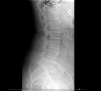 <i>Aerococcus urinae</i> Spondylodiscitis: A Case Report and Review of the Literature.