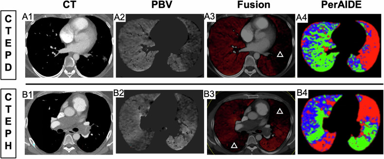 Development of a lung perfusion automated quantitative model based on dual-energy CT pulmonary angiography in patients with chronic pulmonary thromboembolism.