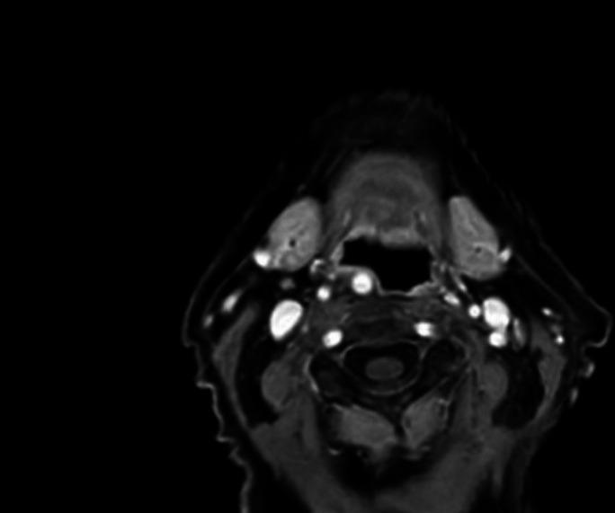 Dysphagia from an aberrant internal carotid artery: a case report.