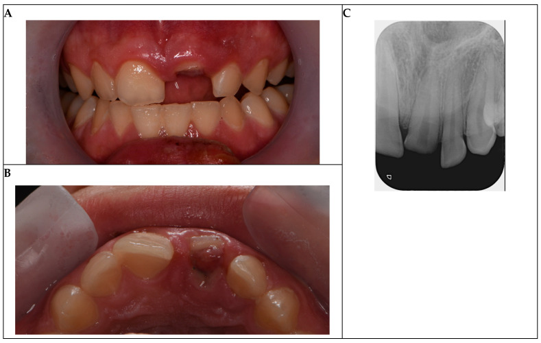 Management of a Complicated Crown Fracture in a 16-Year-Old Patient: A Case Report.