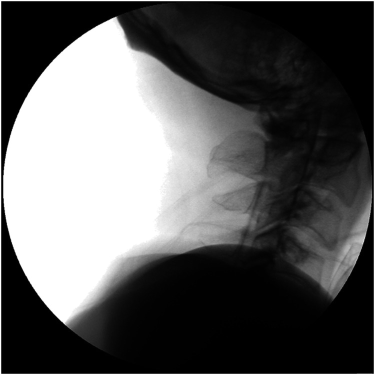 Misdiagnosis of supraclavicular brachial plexus metastasis as cervical disc herniation: A lung cancer case report.