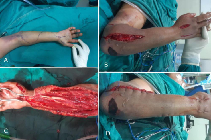 Compartment syndrome of upper limb following snake bite, a case report.
