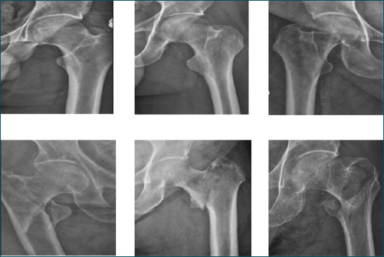 Detection and classification of femoral neck fractures from plain pelvic X-rays using deep learning and machine learning methods.