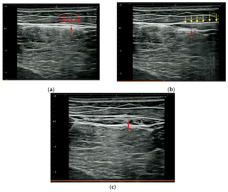 Ultrasound-Guided Fascial Hydrorelease for Persistent Pain After Hamstring Injury.