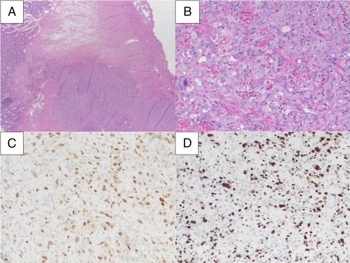 Primary Jejunal Angiosarcoma.