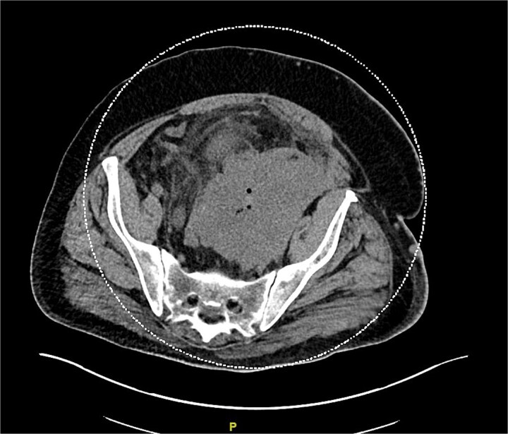 Atypical presentation of Merkel cell carcinoma with pulmonary embolism.