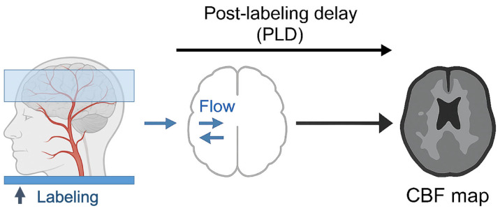 Prognostic Utility of Arterial Spin Labeling in Traumatic Brain Injury: From Pathophysiology to Precision Imaging.