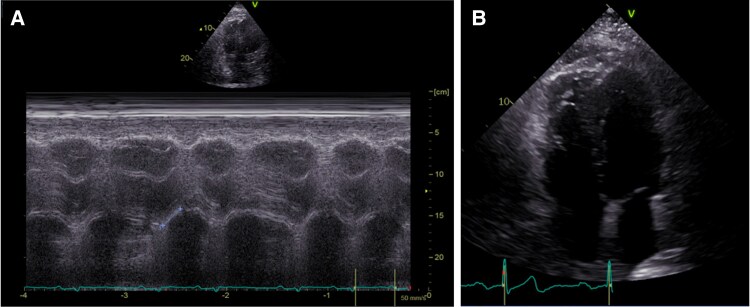 In-hospital cardiac arrest due to acute pulmonary embolism: a case report of successful catheter-directed thrombectomy on a patient with VA-ECMO.
