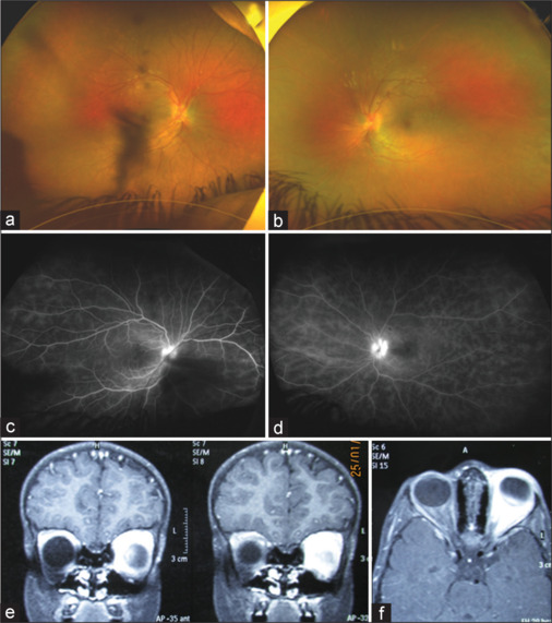 A curious case of Panuveitis with proptosis in a young girl.
