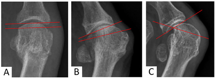 Correction of Severe Hallux Valgus Deformity Using a Percutaneous Metatarsal Distal Osteotomy.