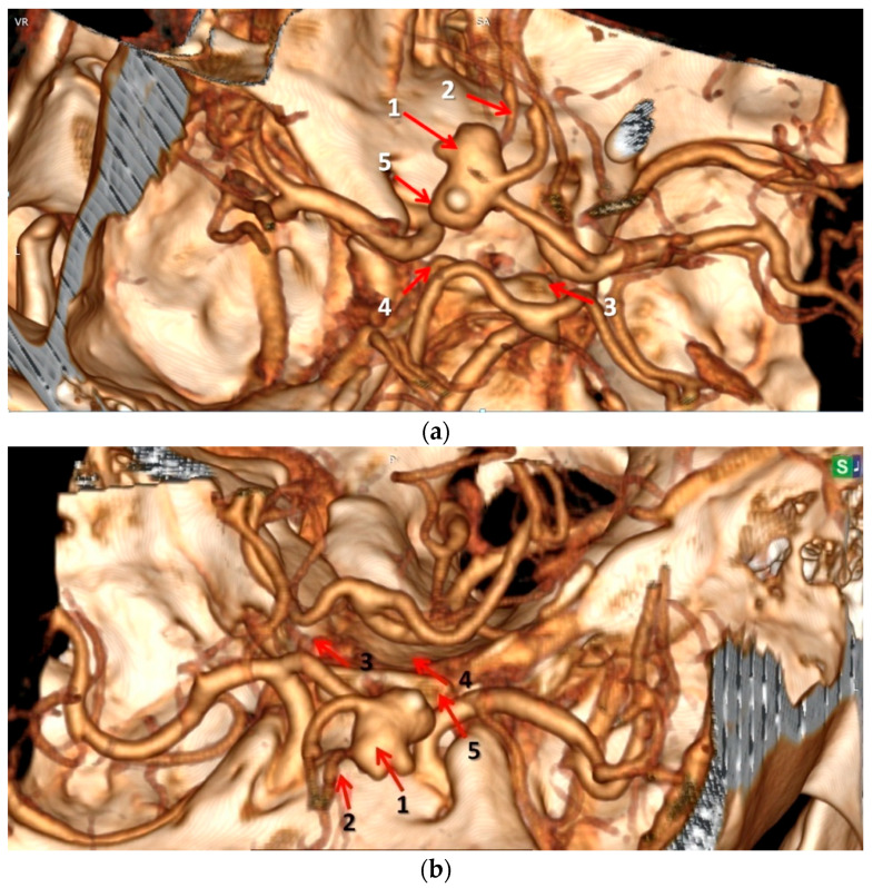 Comparing Antemortem CT-Angiography Data with Autopsy Findings in Regard to Anterior Communicating Artery Aneurysms.