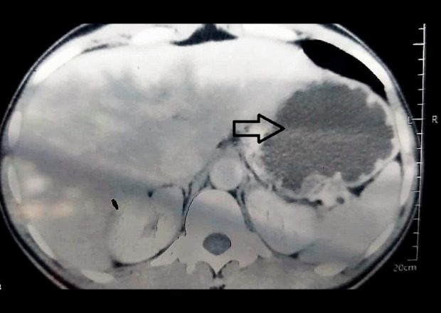Uncommon Ileo-Cecal Intussusception in Adults: A Case Report of Diagnosis and Management.