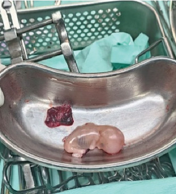 Hemorrhagic Shock in Primary Hepatic Pregnancy: A Diagnostic and Surgical Challenge.