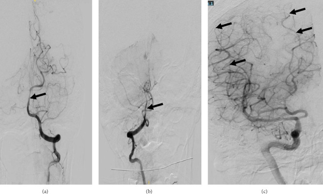 Presumed Cerebral Vasculitis Following Pneumococcal Meningitis: A Rare but Life-Threatening Complication.