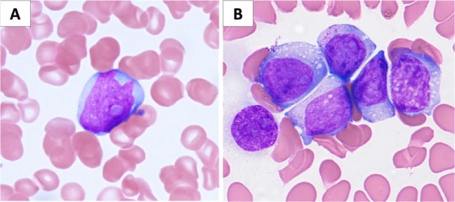 Lineage Switch of Adult B-Cell Acute Lymphoblastic Leukaemia to Acute Myeloid Leukaemia Following B-Cell-Directed Therapy.