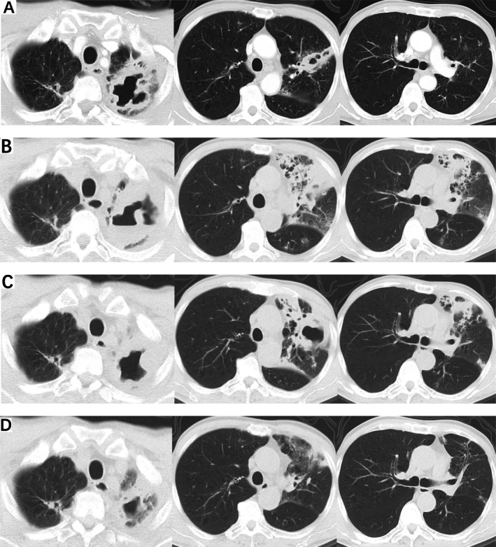 Lenvatinib-Associated Non-Tuberculous Mycobacterial Pulmonary Disease: A Case Report.